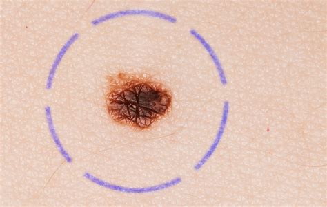 What Does Stage 2 Melanoma Look Like Symptoms And Pictures