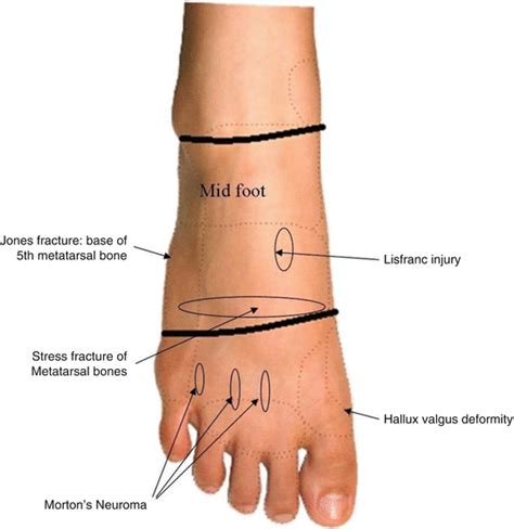 The Foot Musculoskeletal Key