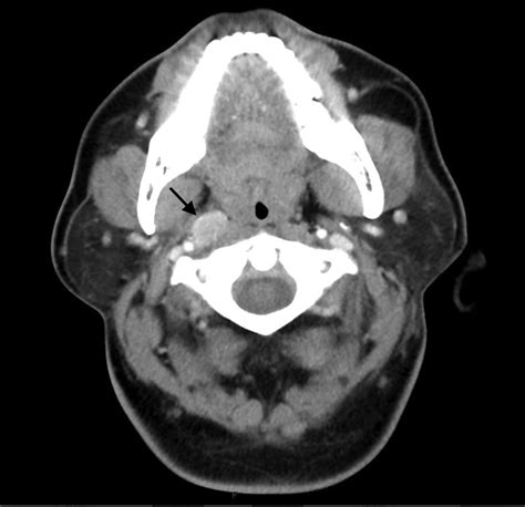 Surgical Management Of Parapharyngeal Lymph Node Metastases From