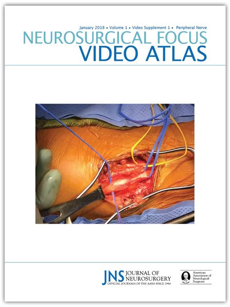 Peroneal Nerve Decompression In Neurosurgical Focus Volume 44 Issue