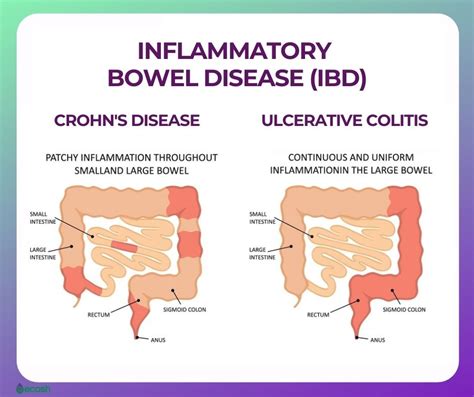 Inflammatory Bowel Disease Ibd Symptoms Causes Risk Factors And Natural Treatment Ecosh