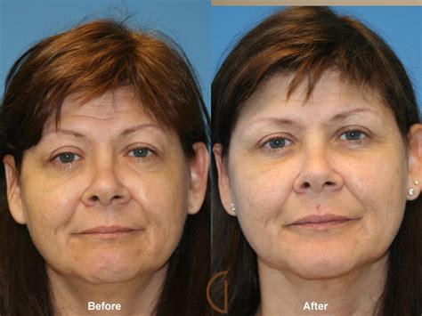 Facial Fat Grafting Aliso Viejo Ca Before After Photo 26