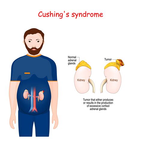 Cushings Syndrome Medic Drive