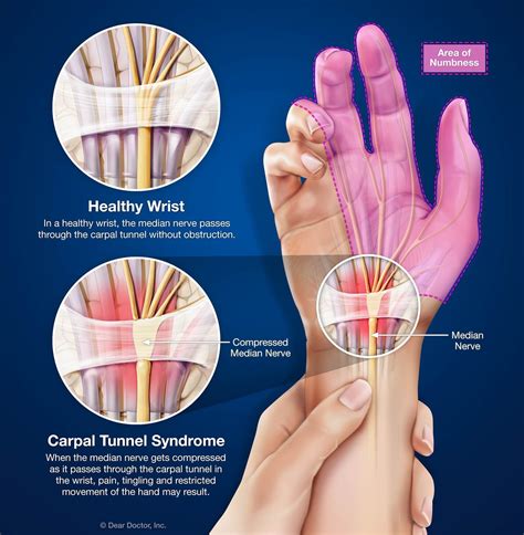 Carpal Tunnel Syndrome Sports Chiropractor In Guilderland Ny
