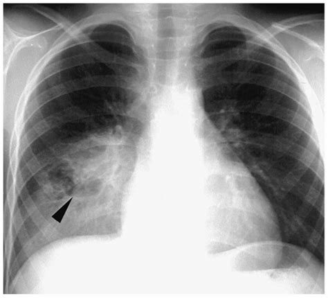 Lung Pleura And Chest Wall Radiology Key