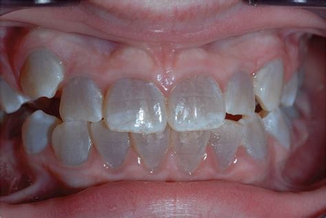 Discoloration Of Teeth Visual Diagnosis And Treatment In Pediatrics