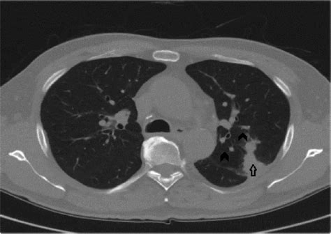 Initial Ct Scan Of The Chest Showing Left Lung Mass Arrow Nodules