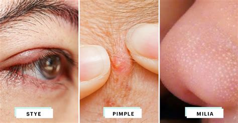 A Visual Guide To Identifying The Little Bump On Your Eyelid Skin