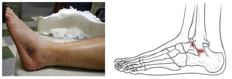 Strained ankle tendon vs sprained ankle ligaments: Anatomy of an ankle sprain | BoulderCentre for Orthopedics ...