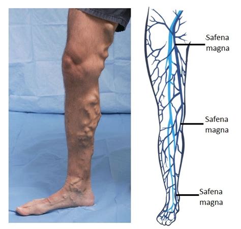 Deep Vein Thrombosis Physiopedia