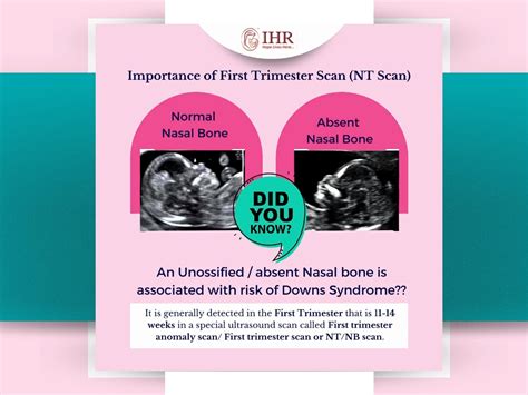 Absent Nasal Bone In First Trimester Scan Assocated With Down Syndrome