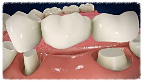 Dental Bridges Front Teeth Procedure Problems Vs Last Cost