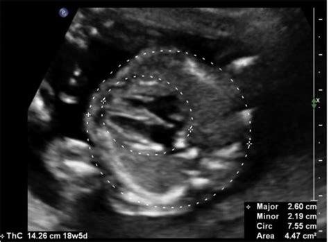 Prenatal Prediction Of Pulmonary Hypoplasia Seminars In Fetal And Neonatal Medicine