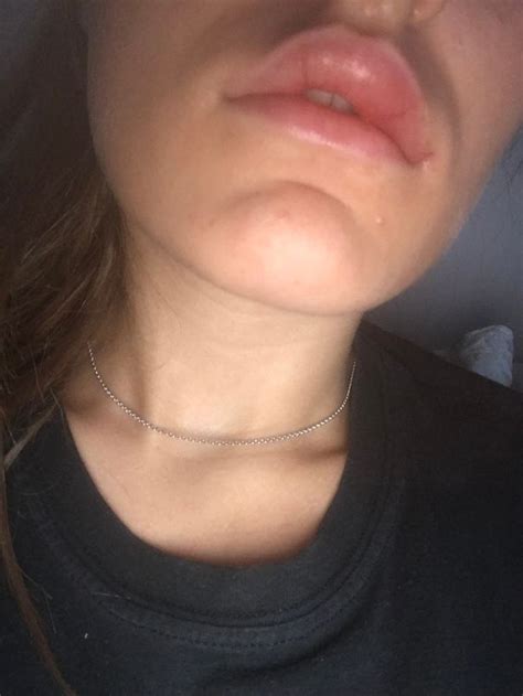 Woman Who Claims Bad Fillers Left Her With Concrete Lips Issues Stark