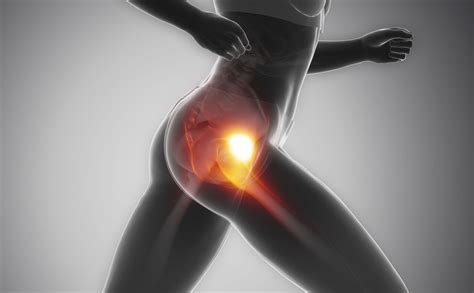 What Is Snapping Hip Syndrome