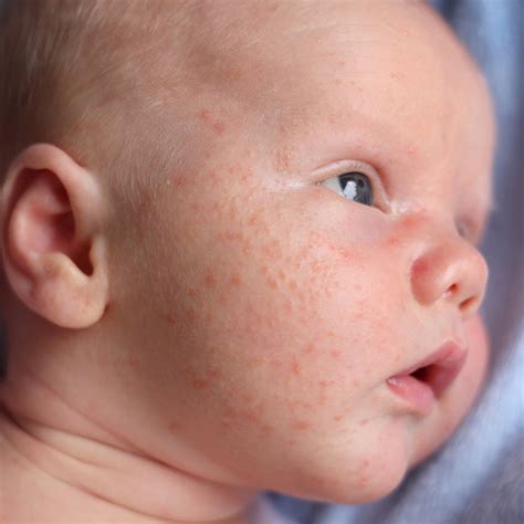 6 Perguntas E Respostas Sobre Acne Neonatal