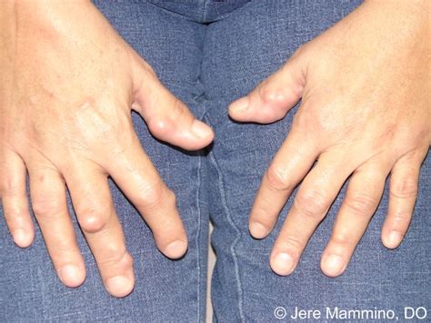 Rheumatoid Nodules American Osteopathic College Of Dermatology Aocd