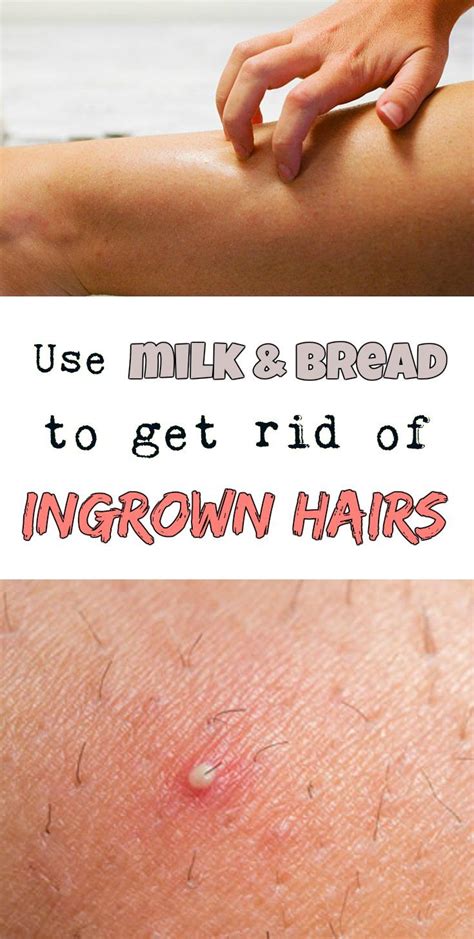 Use Milk And Bread To Get Rid Of Ingrown Hairs Heres How Ingrown Hair