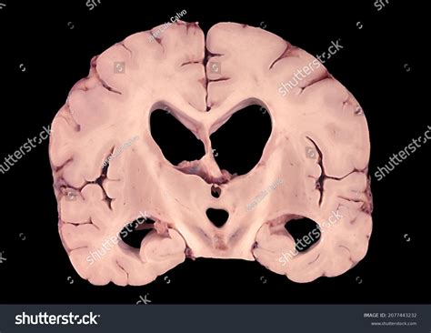 Human Brain Showing Lateral Ventricles Enlarged Stock Foto 2077443232