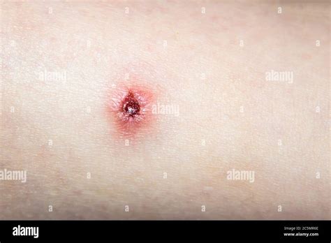Torn Wound From Inflammation Acne On The Human Skin Red Infected