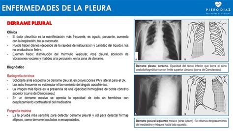 DERRAME PLEURAL Pierodiaz Med Pierodiaz Med UDocz