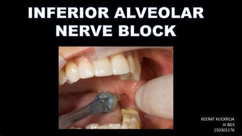 Inferior Alveolar Nerve Block Ppt