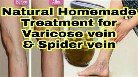 How To Get Rid Varicose Vein And Spider Vein Homemade Remedy Treatment