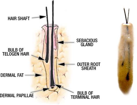 Can Hair Transplant Surgery Really Produce Natural And Undetectable