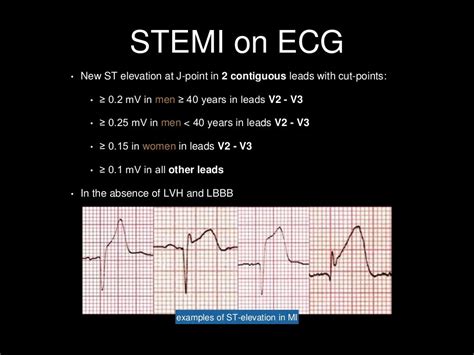 Stemi Criteria