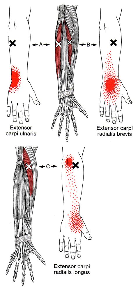 Extensor Carpi Ulnaris The Trigger Point And Referred Pain Guide
