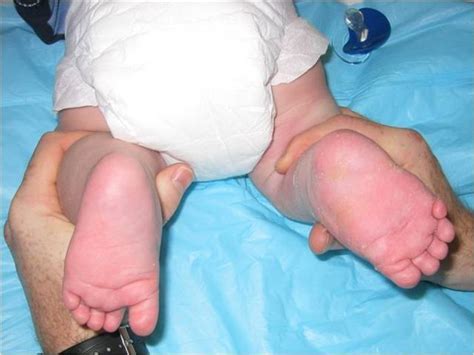 Note the low heel on the left foot and the high heel on the right foot. Clubfoot Ponseti Casting - Advanced Foot and Ankle