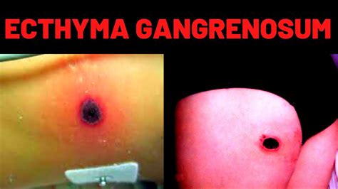 What Is Ecthyma Gangrenosum Causes Symptoms Youtube