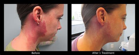 Port Wine Stainsbirthmark Removal Connecticut Skin Institute