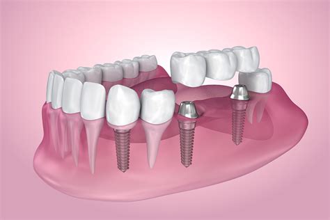 3 Types Of Dental Implants Dentist In Asheville Nc