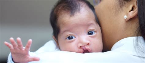 Preparing For A Baby With A Cleft Lippalate Diagnosis