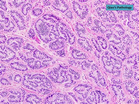 Qiaos Pathology Rectal Carcinoid Tumor Microscopic Photo Flickr