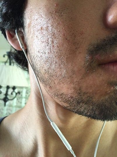 How Bad Are My Acne Scars And What Can I Do To Reduce The