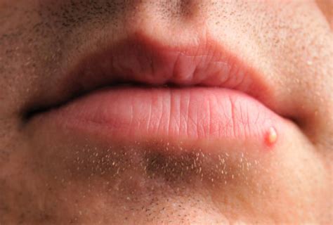 How To Get Rid Of Lip Pimples For Good The Ultimate Guide