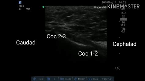 Ultrasound Guided Injection For Pain Relief In A Case Of Coccydenia