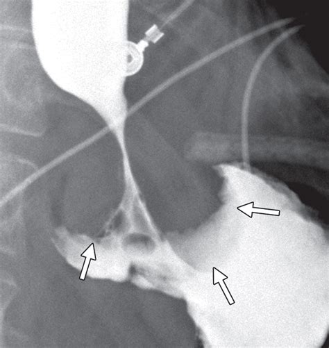 Imaging Findings Of Successful And Failed Fundoplication Radiographics