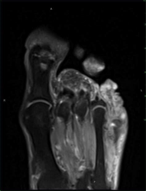 Squamous Cell Carcinoma 5th Digit Foot Musculoskeletal Case Studies