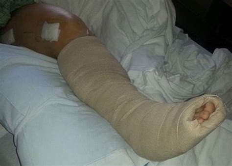 Mum Reveals Horrific Broken Bones And Crushed Legs After Resting Feet