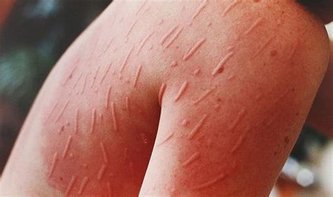 What Causes Urticaria How It Is Linked With Fibromyalgia