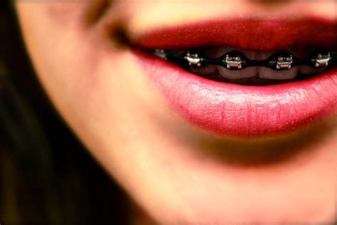 What Is The Best Way To Pay For Braces