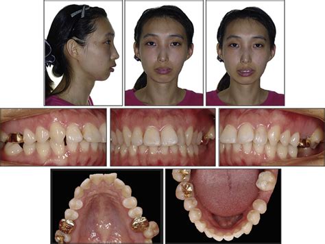Orthodontic Uprighting Of A Horizontally Impacted Third Molar And