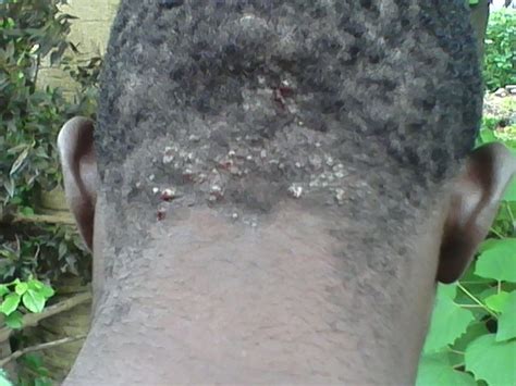 Please Help Barbers Rashes At Back Of Head Health Nigeria