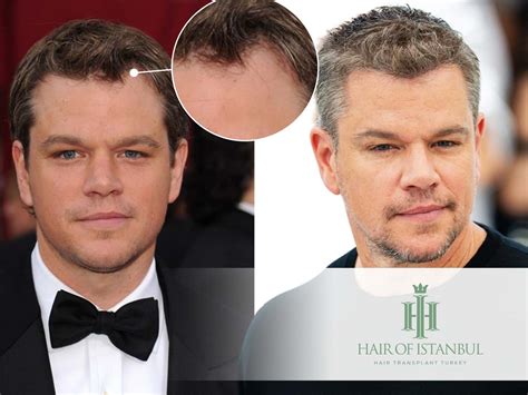 The Real Story Behind Matt Damon S Alleged Hair Transplant