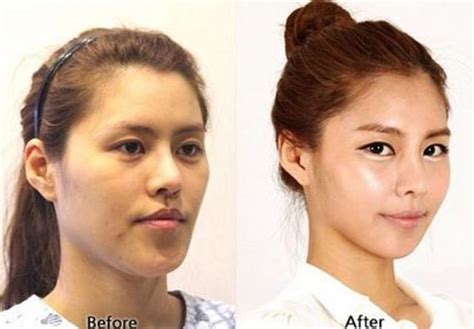 These Amazing Transformation After Their Plastic Surgery Will Blow Your