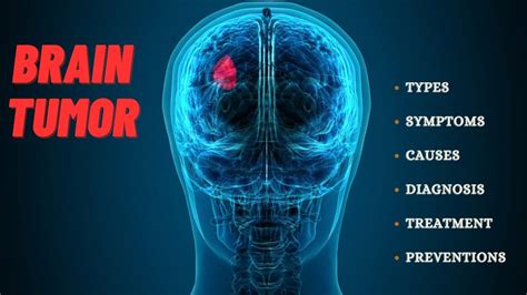 Brain Tumor Symptoms Causes Treatment Youtube