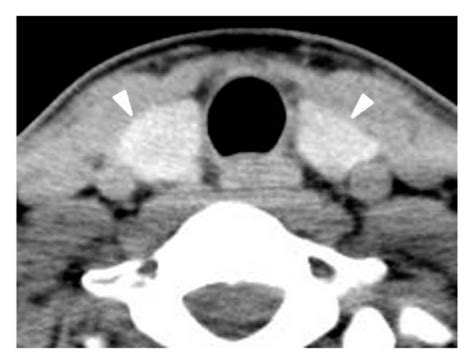 Normal Thyroid Designated “normal” Ct Diagnosis In A 28 Year Old Woman